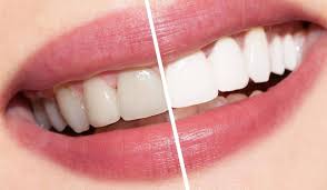 كيفية تبييض الاسنان بوصفات طبيعية